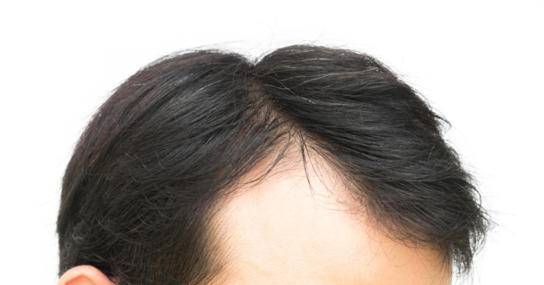 Different Hair Transplant Techniques